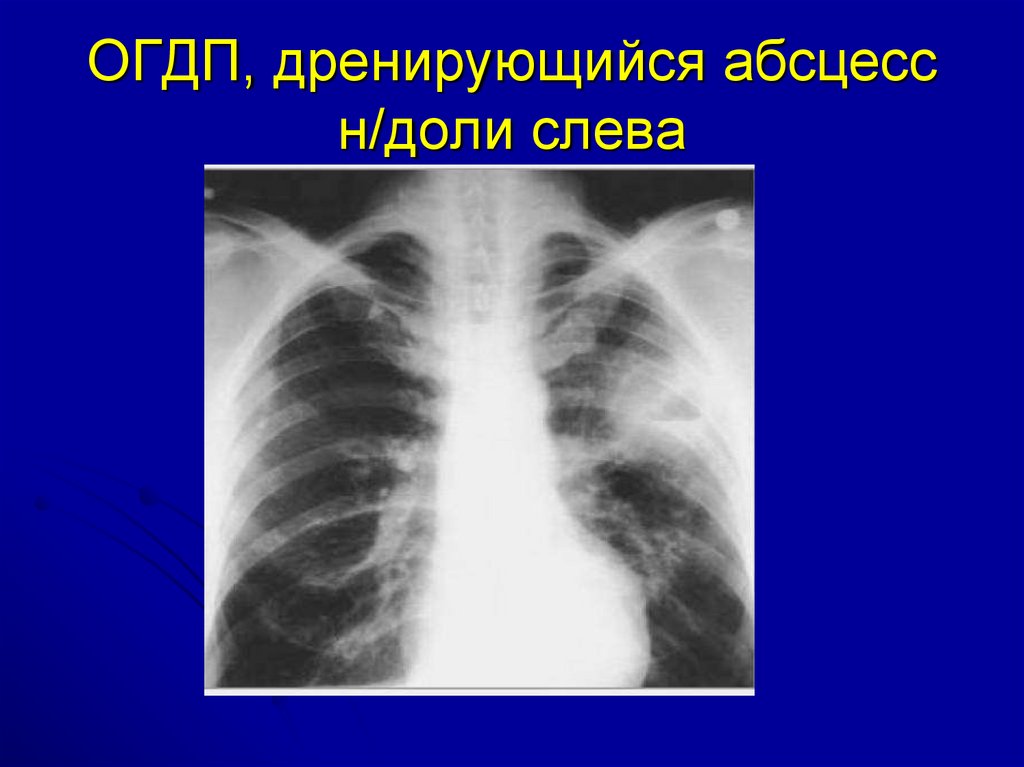 Деструктивная пневмония. Острая гнойная деструктивная пневмония у детей. Аспирационный абсцесс. Острая деструктивная пневмония у детей. Аспирационный абсцесс легкого.