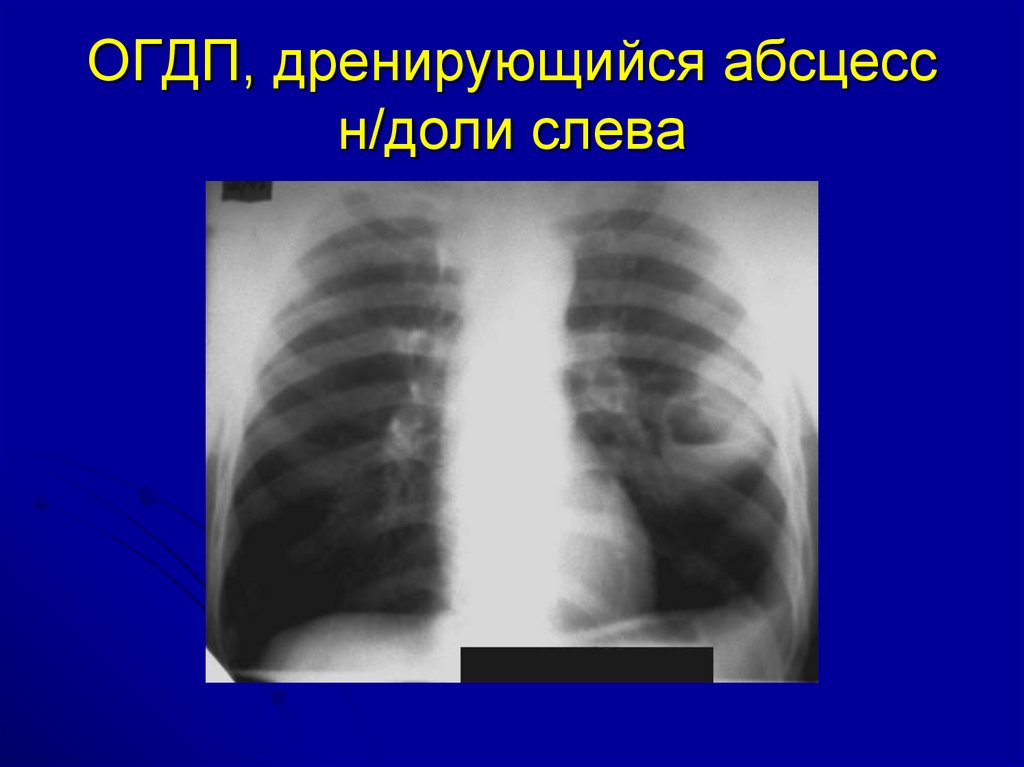 Деструктивная пневмония. Острая гнойная деструктивная пневмония. Острая гнойная деструктивная пневмония у детей. Абсцесс легкого при пневмонии.