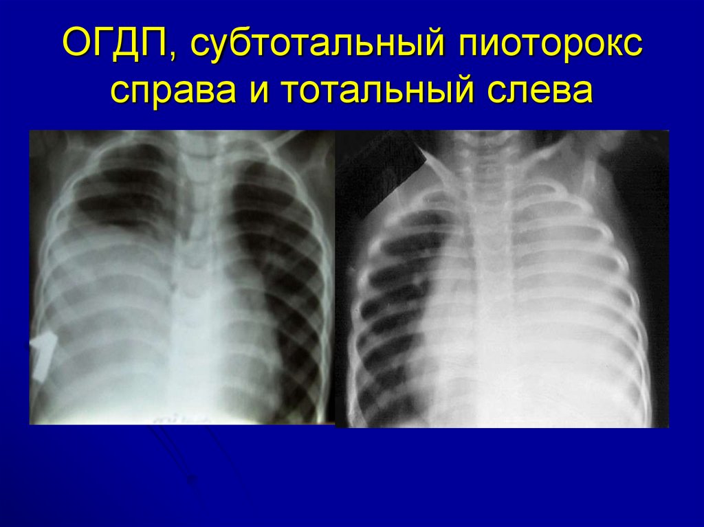 Пиоторакс это. Острая гнойная деструктивная пневмония. Острая гнойная деструктивная пневмония у детей. Острая деструктивная пневмония у детей. Тотальная и субтотальная пневмония.