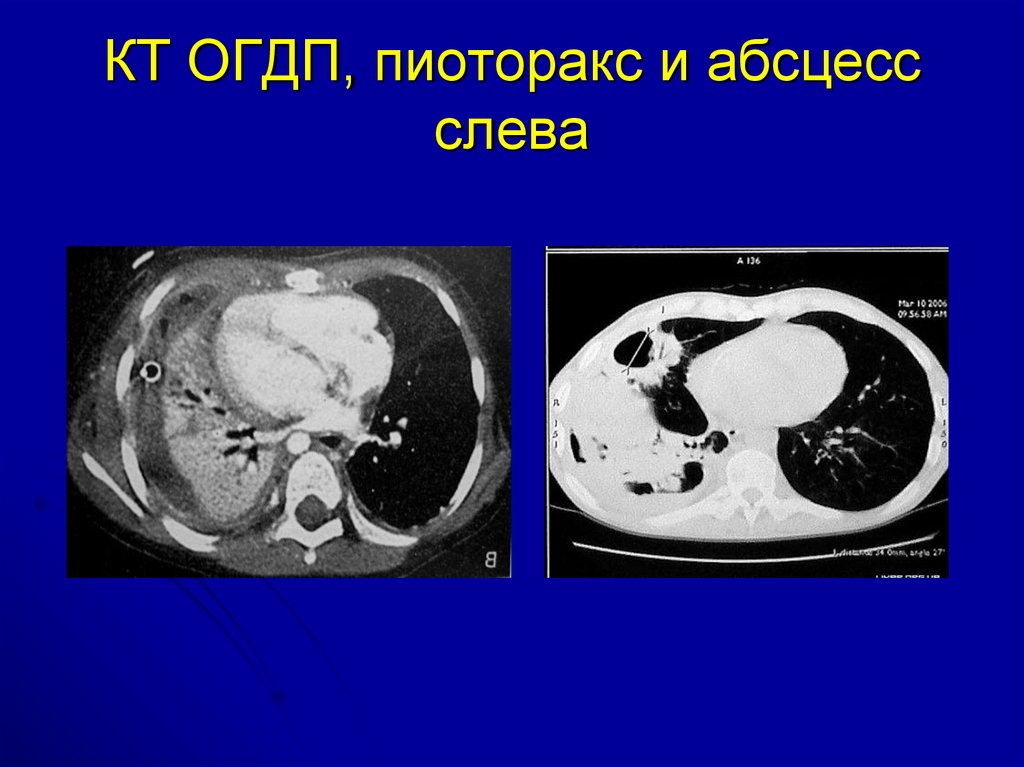 Пиоторакс это. Острая гнойная деструктивная пневмония.