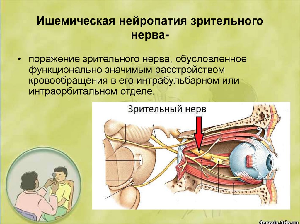 Ишемия нерва. Задняя ишемическая нейропатия зрительного нерва. Передняя ишемическая невропатия зрительного нерва. Передняя ишемическая оптиконейропатия зрительный нерв. Ишемическая нейрооптикопатия зрительного нерва.