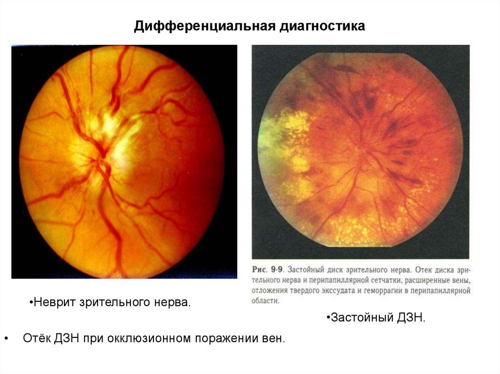 Нейропатия глаза. Неврит глазного нерва ретробульбарный. Нейрооптикопатия зрительного нерва. Опухоли зрительного нерва глазное дно. Ретробульбарный неврит (папиллит).