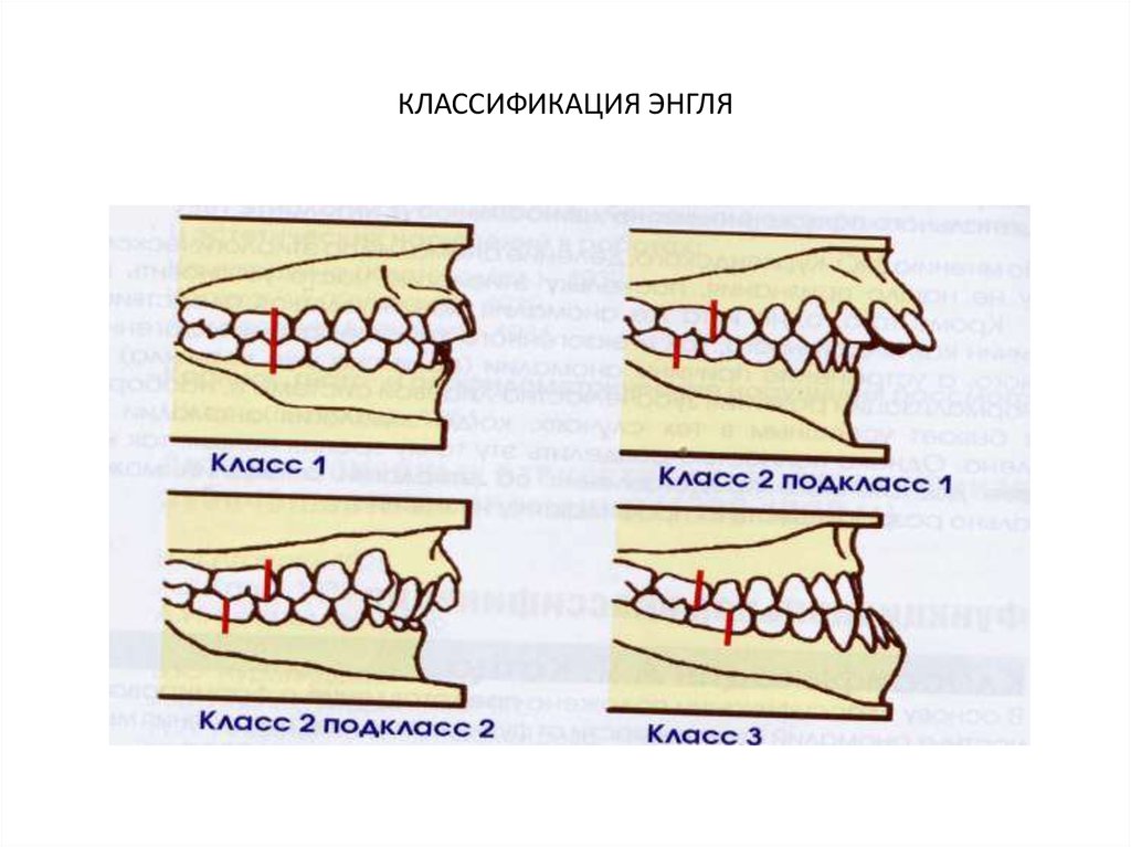 Классы окклюзии. (II класс Энгля, 1 подкласс). Классификация Энгля зубочелюстных аномалий. Аномалии прикуса по Энглю. II класс Энгля характеризуется смещением зубов.