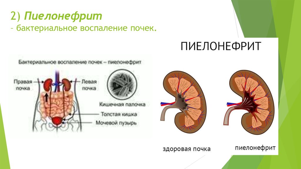 Как лечить воспаление почек