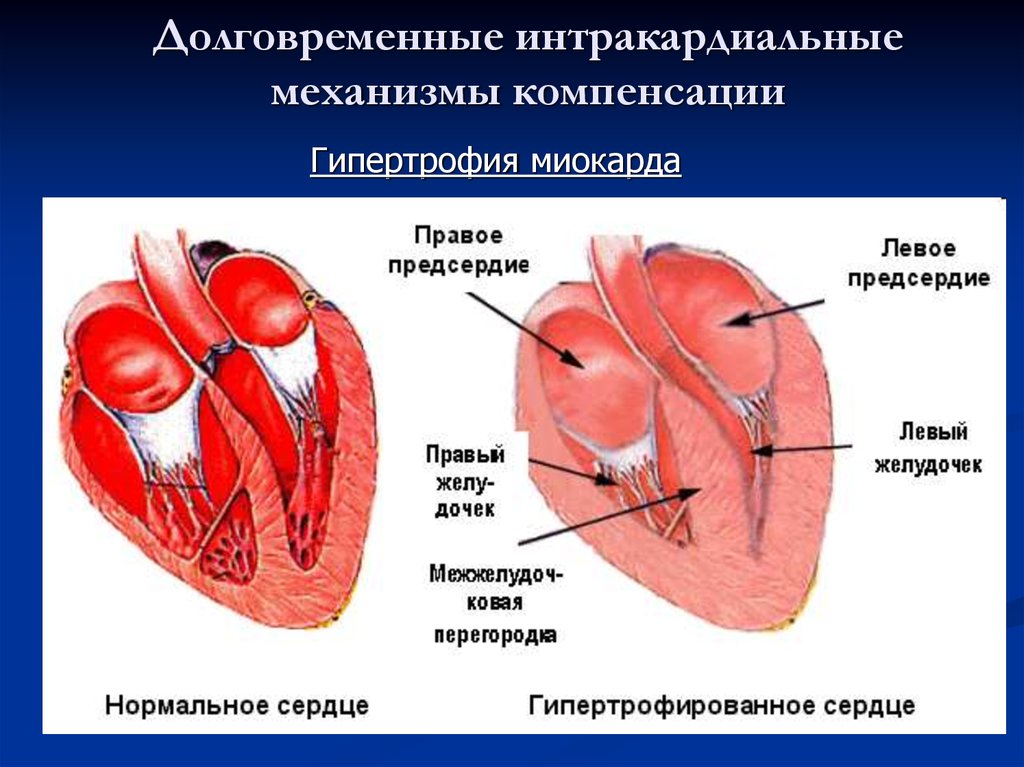 Миокард правого желудочка сердца. Спортивное сердце гипертрофия миокарда. Симметричная гипертрофия миокарда. Правый желудочек сердца.