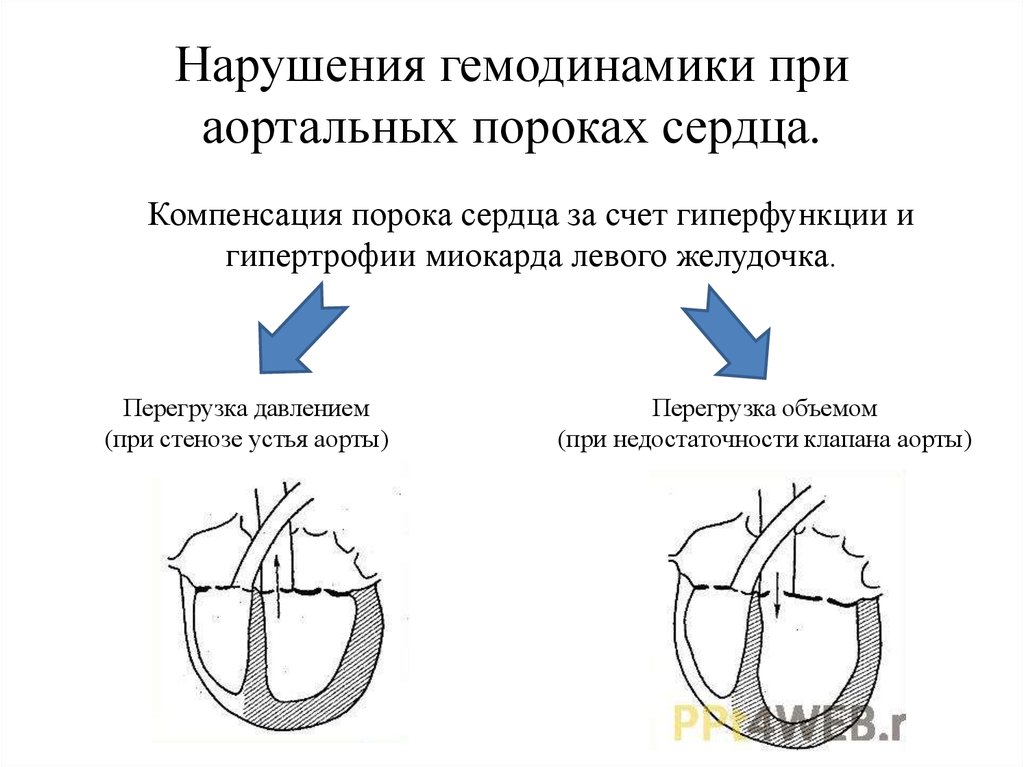 Митральный аортальный стеноз. Механизмы нарушения гемодинамики при пороках сердца. Пороки сердца аортальный стеноз и недостаточность. Механизмы нарушения гемодинамики приобретенные пороки сердца. Аортальные пороки сердца схема.