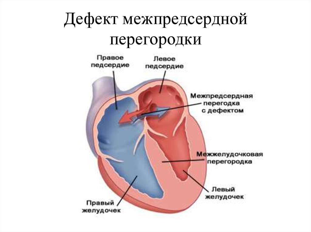 В левое предсердие открываются. Порок сердца вторичный дефект межпредсердной перегородки у детей 5 мм. ВПС межжелудочковой перегородки. Дефект предсердной перегородки у ребенка.