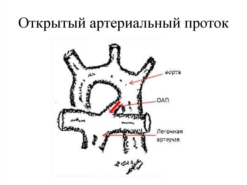 Открытый артериальный проток схема