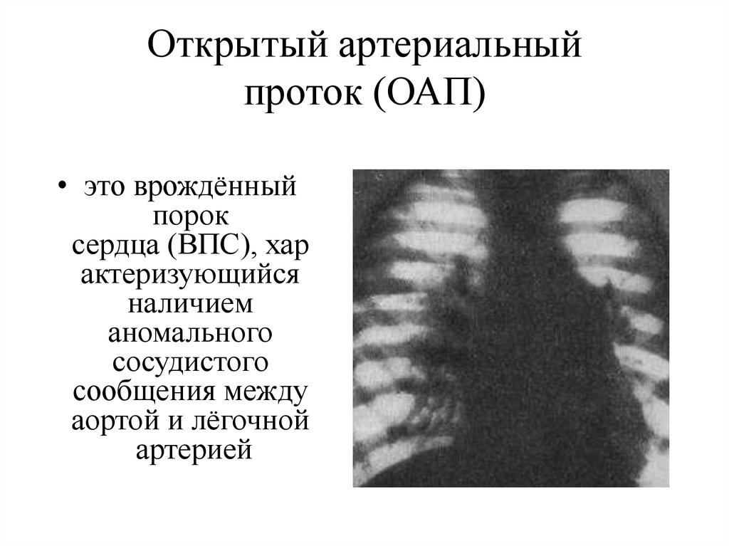 Открытый артериальный проток. Рентген при открытом артериальном протоке. Незаращение боталлова протока рентген. Открытый артериальный проток рентген. Открытый артериальный проток у детей на рентгене.