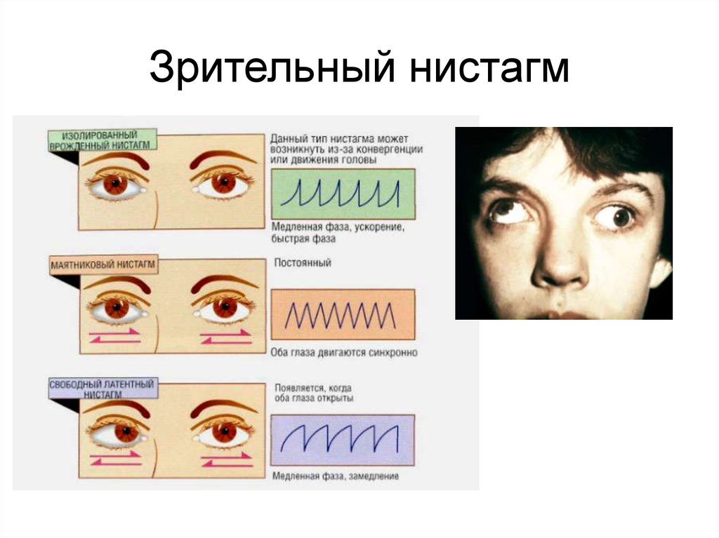 Ротаторный нистагм. Нистагм глазного яблока. Зрительный нистагм. Горизонтальный нистагм. Спонтанный горизонтальный нистагм.