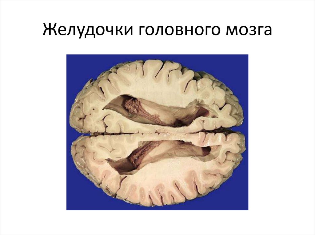 Правый желудочек головного. Боковые желудочки головного мозга анатомия. Желудочки мозга макропрепарат. 3 И 4 желудочки головного мозга. Третий желудочек головного мозга анатомия.