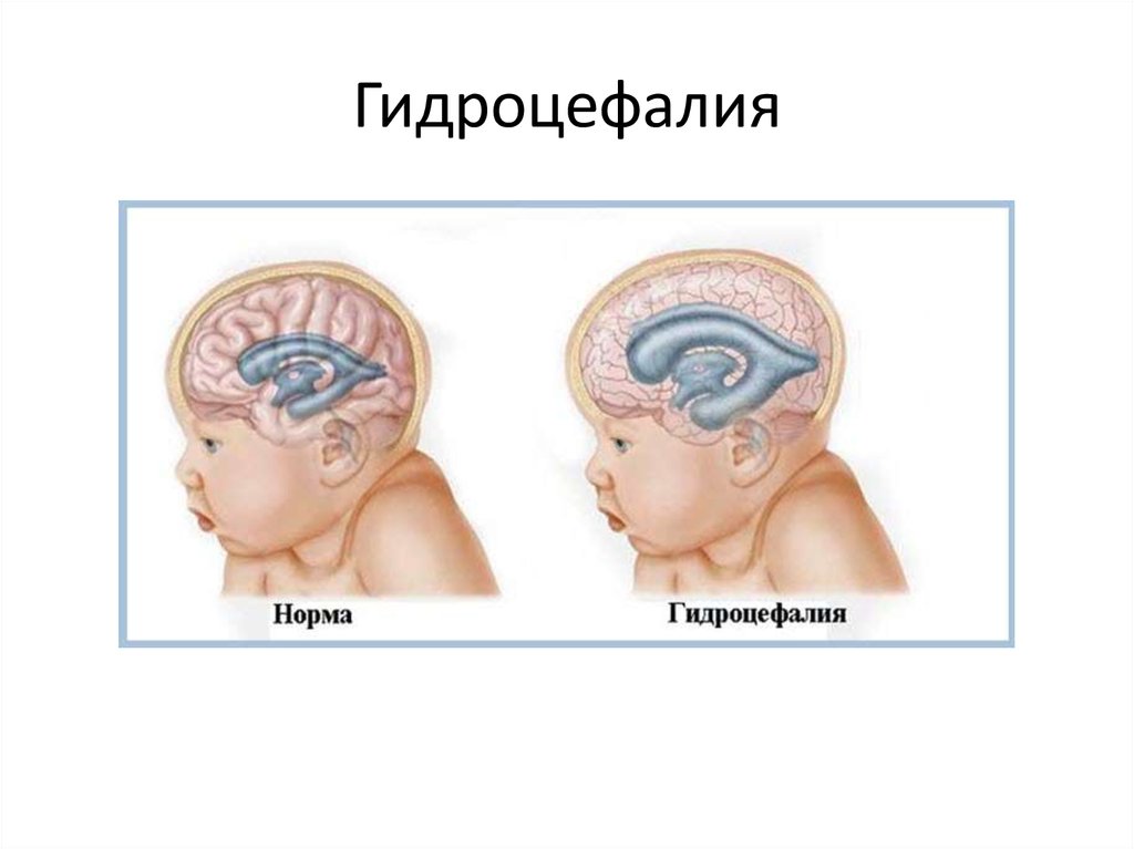 Гидроцефалия что это. Врожденные патологии. Гидроцефалия.. Черепно мозговая грыжа гидроцефалия. Врожденный токсоплазмоз гидроцефалия. УЗИ мозга гидроцефалия.