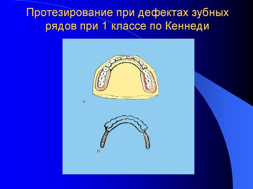 Дефекты зубных рядов. Бюгельный протез 3 класс по Кеннеди. 1 Класс по Кеннеди бюгельный протез. 3 Класс по Кеннеди. Бюгельный протез 2 класс по Кеннеди.