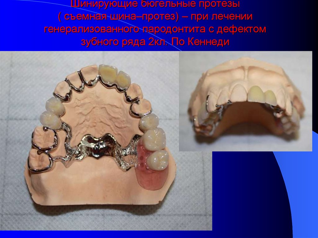 Бюгельные протезы презентация