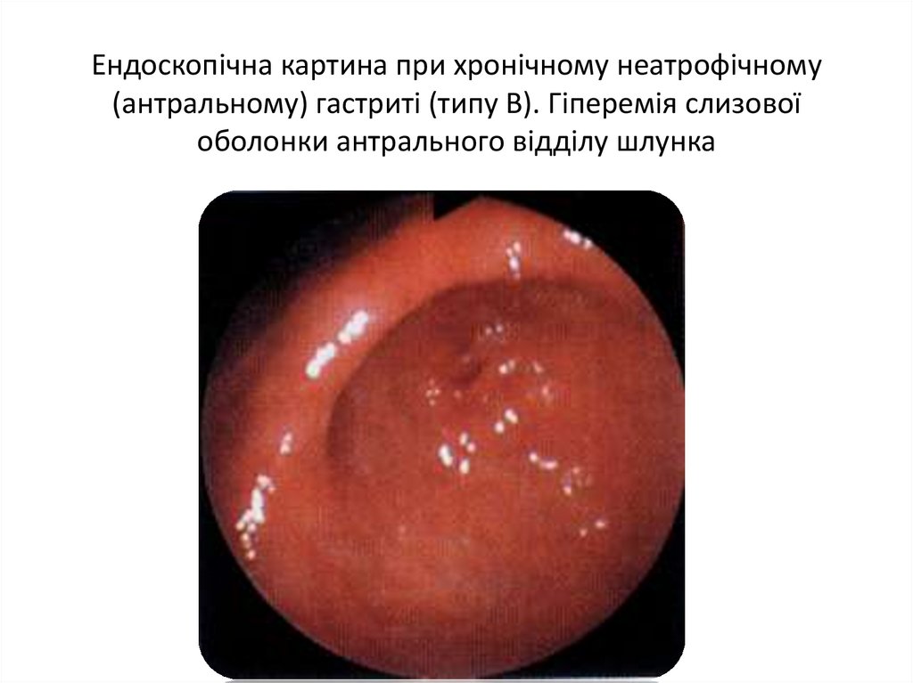 Ендоскопічна картина при хронічному неатрофічному (антральному) гастриті (типу В). Гіперемія слизової оболонки антрального