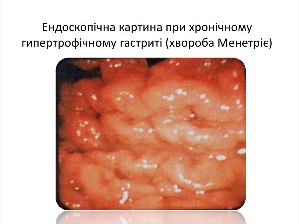 Ендоскопічна картина при хронічному гипертрофічному гастриті (хвороба Менетріє)