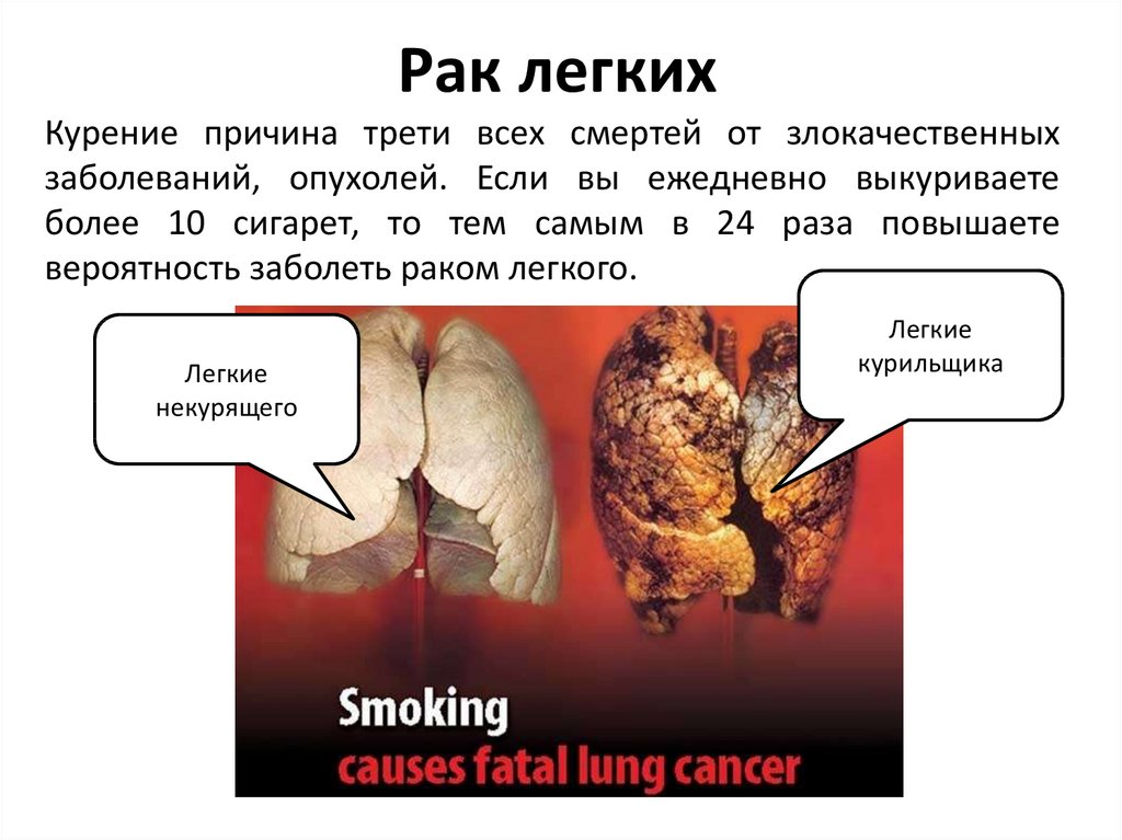 Рак легких