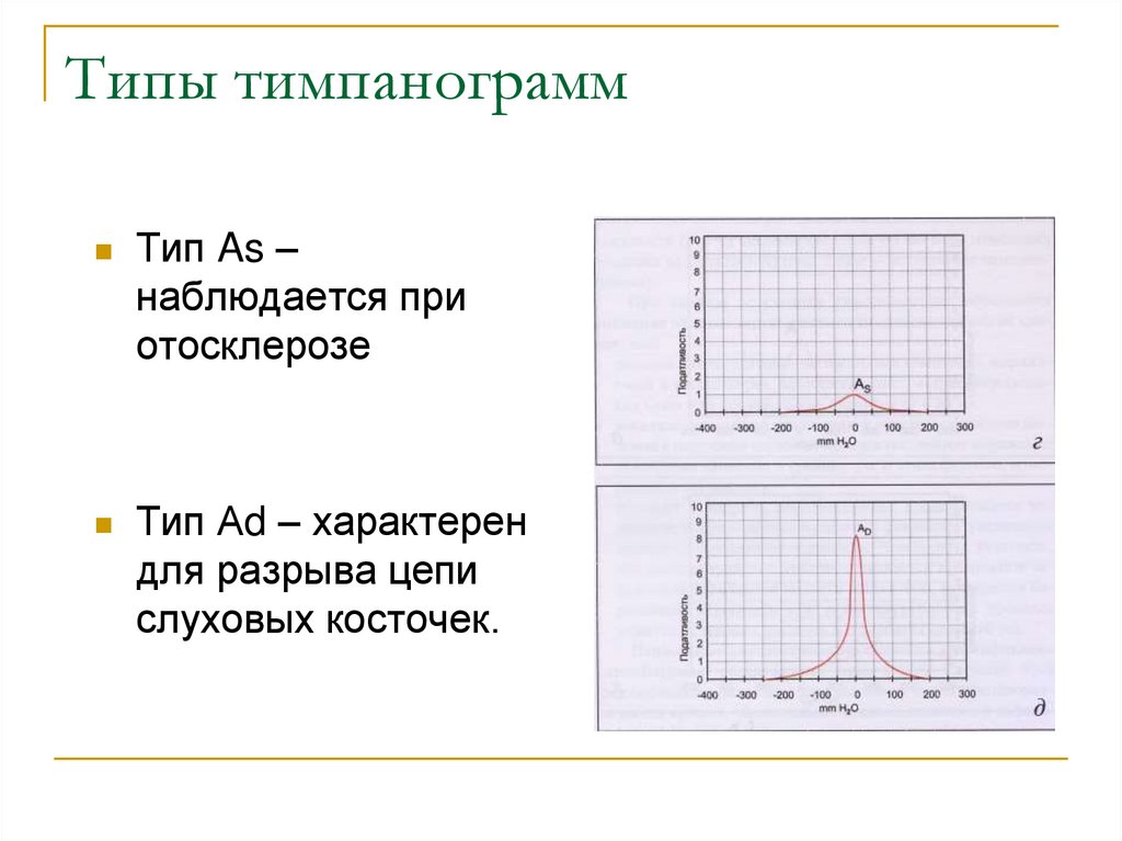 Типы тимпанограмм