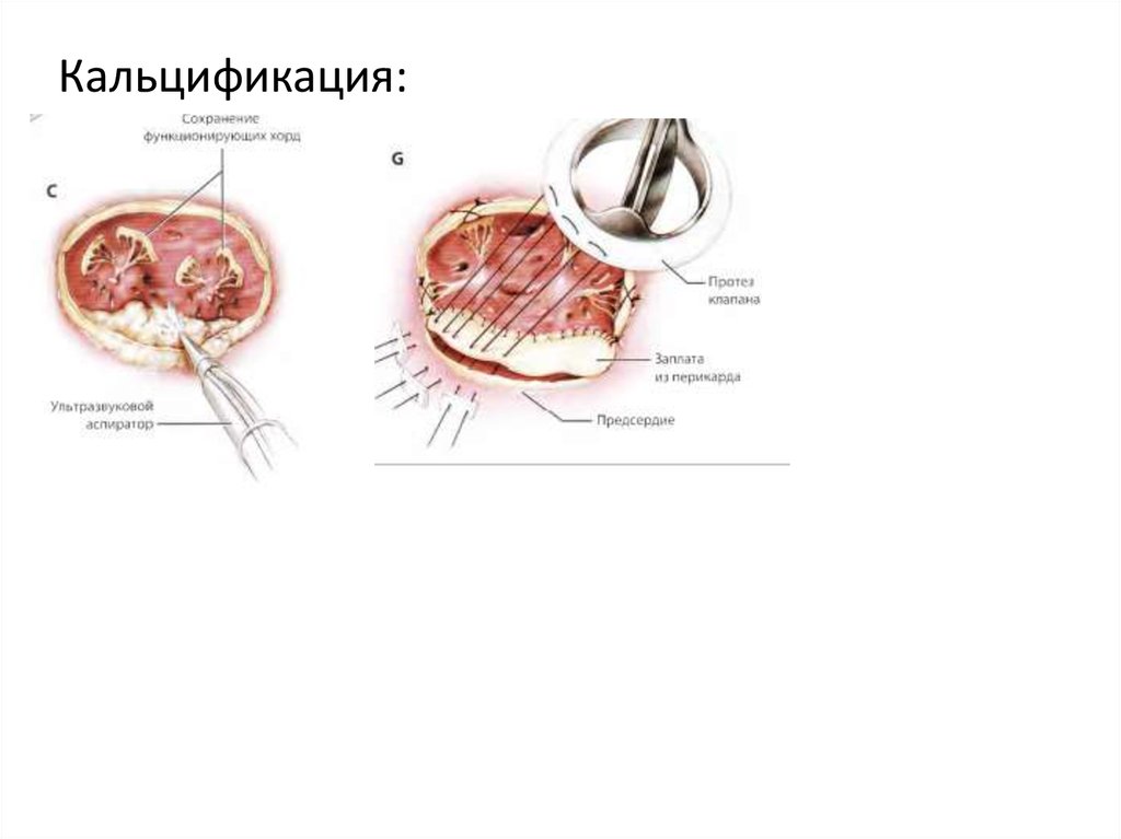 Замена митрального клапана последствия