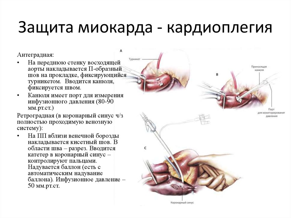 Вегетации на митральном клапане