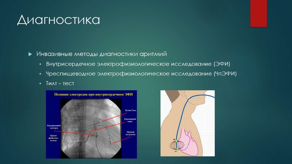 Инвазивный вид. Внутрисердечное электрофизиологическое исследование сердца. Внутрисердечное электрофизиологическое исследование методика. Внутрисердечное электрофизиологическое исследование (эфи). Методы диагностики аритмий.