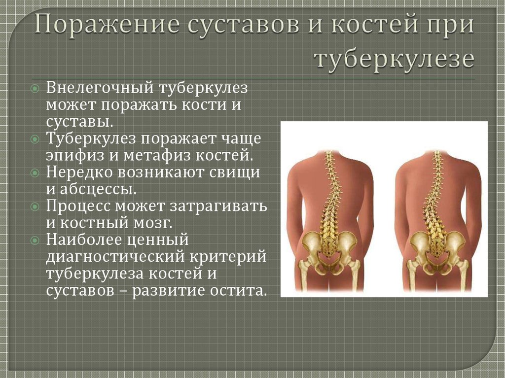 Туберкулез костей картинки