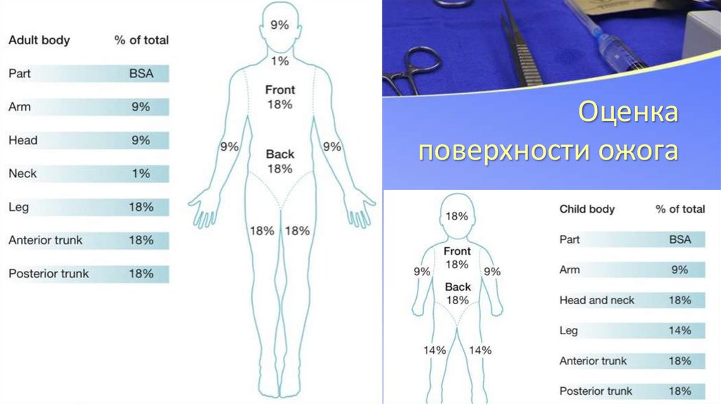 Оценка площади ожога проводится по схеме