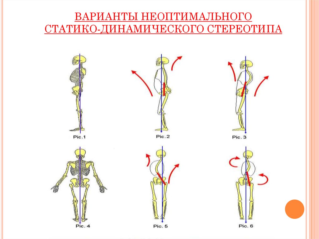 Смещенный центр тяжести. Смещение центра тяжести. Смещение центра тяжести у ребенка. Статико динамическая.