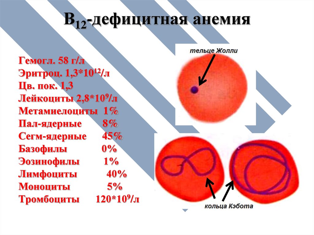 В12 при железодефицитной анемии. Гемоглобин при b12 дефицитной анемии. Симптомы при б12 дефицитной анемии. Витамин б12 дефицитная анемия симптомы. Б12 анемия синдромы.