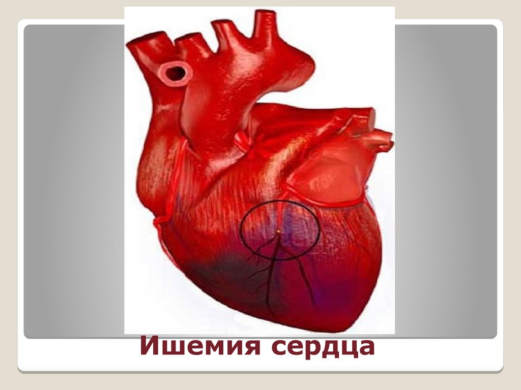 Ишемия т. Патологии сердечной вырезки. Преходящая ишемия сердца. Нарушение кровообращения это ишемия.
