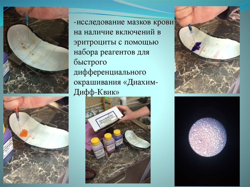 -исследование мазков крови на наличие включений в эритроциты с помощью набора реагентов для быстрого дифференциального