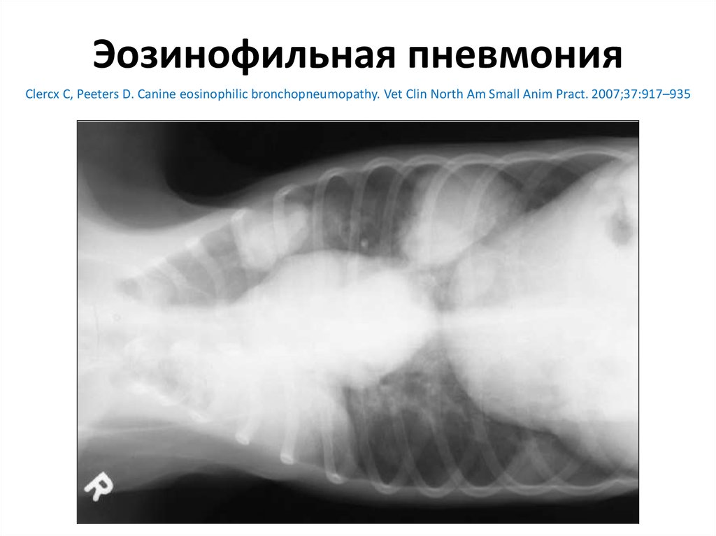 Эозинофильная пневмония презентация