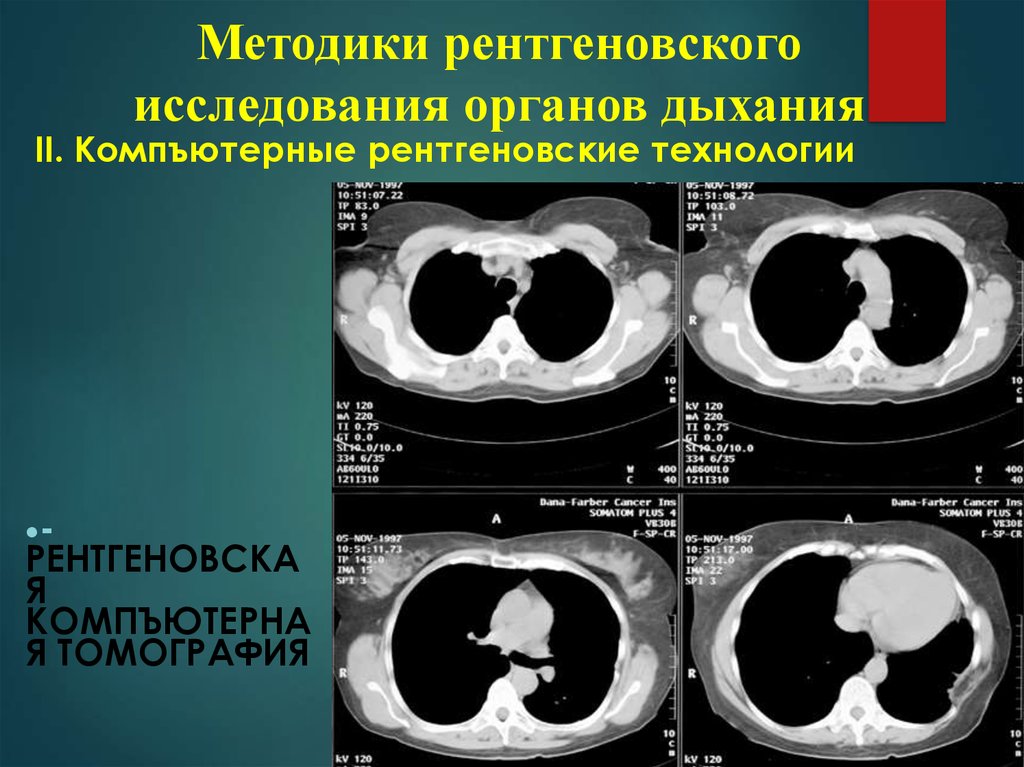 Лучевая диагностика органов дыхания презентация