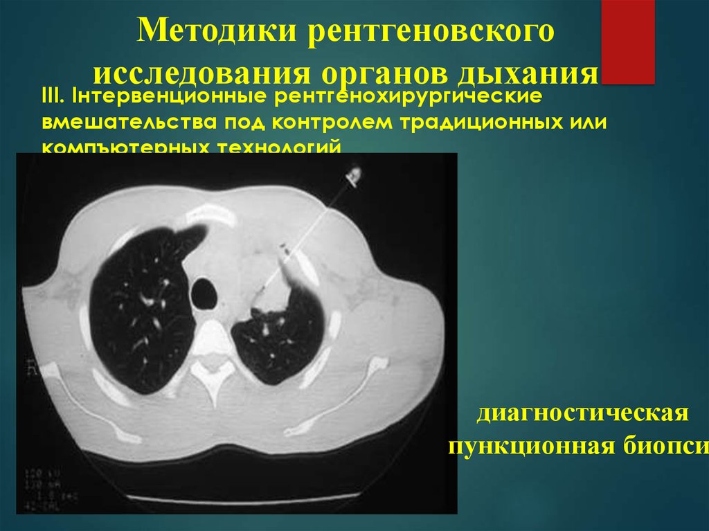 Рентгенологическое исследование органов дыхания. Лучевая диагностика заболеваний органов дыхания. Рентгенологические методы исследования органов дыхания. Лучевые методы исследования органов дыхания. Методы рентгенологического исследования легких.