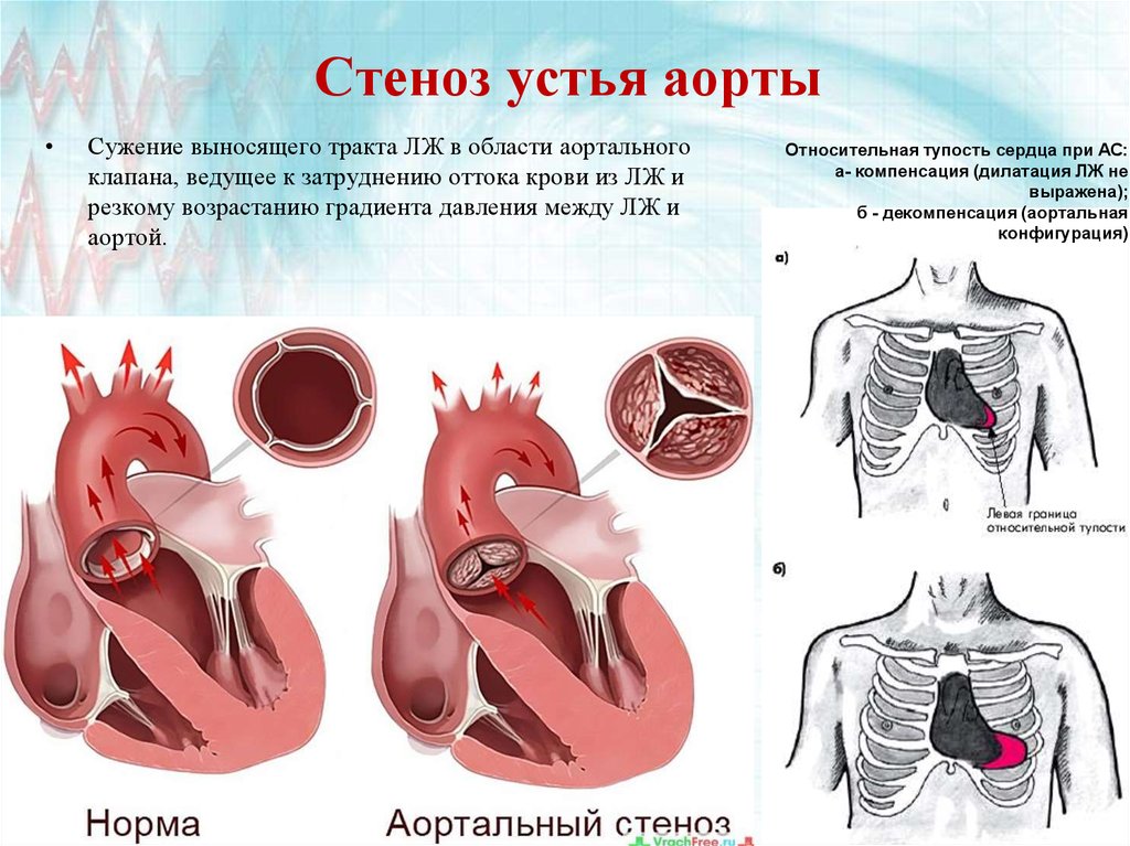 Аортальный стеноз что это такое. Стеноз аортального клапана. Изменения сердца при стенозе устья аорты. Порок сердца стеноз аортального клапана. Стеноз устья аорты у детей.
