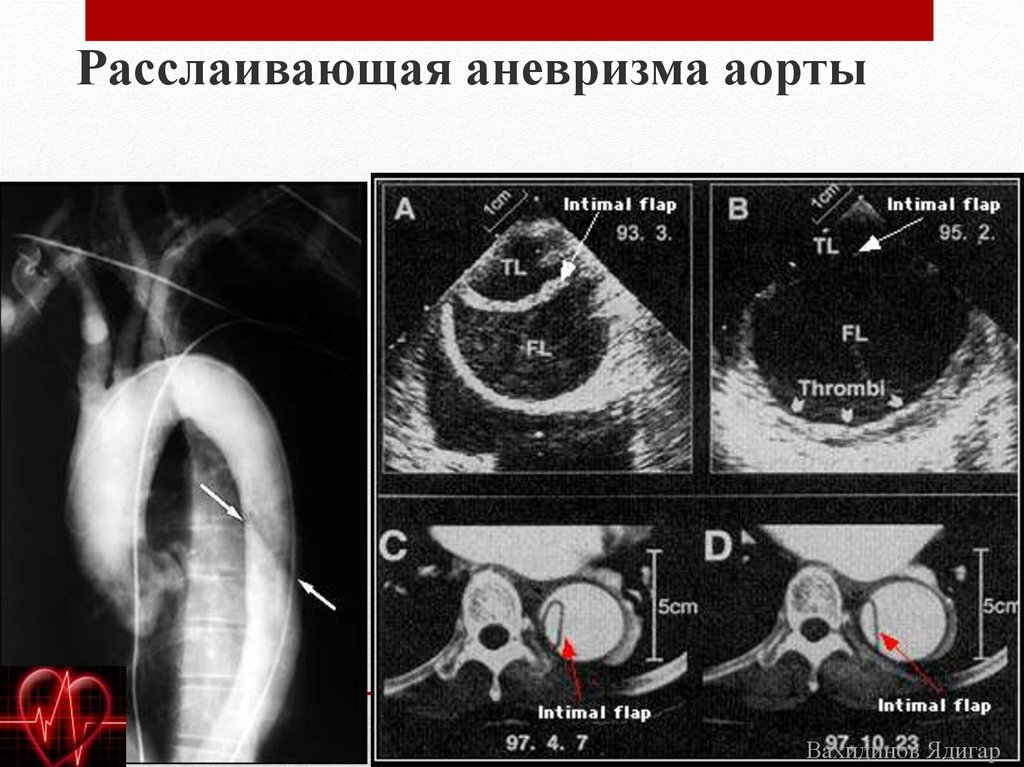 Уплотнение аорты сердца на узи