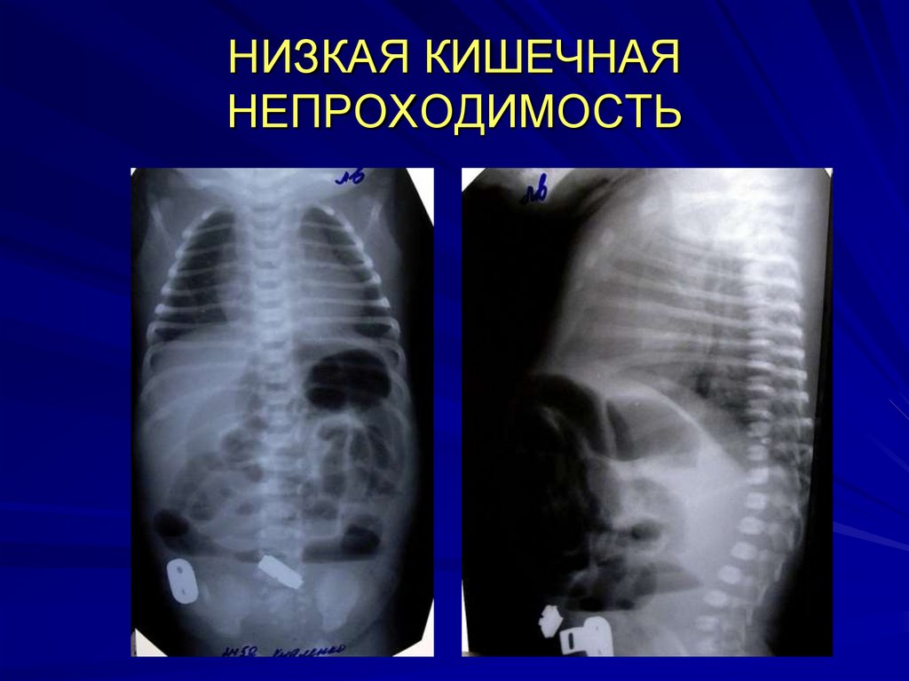 Приобретенная кишечная непроходимость у детей презентация