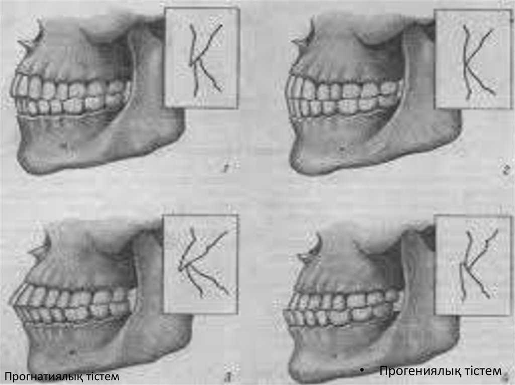 Прогения. Аномалии прикуса прогнатия. Неправильный прикус прогения. Кт челюсти мезиальный прикус. Неправильный прикус прогнатия прогения открытый прикус.