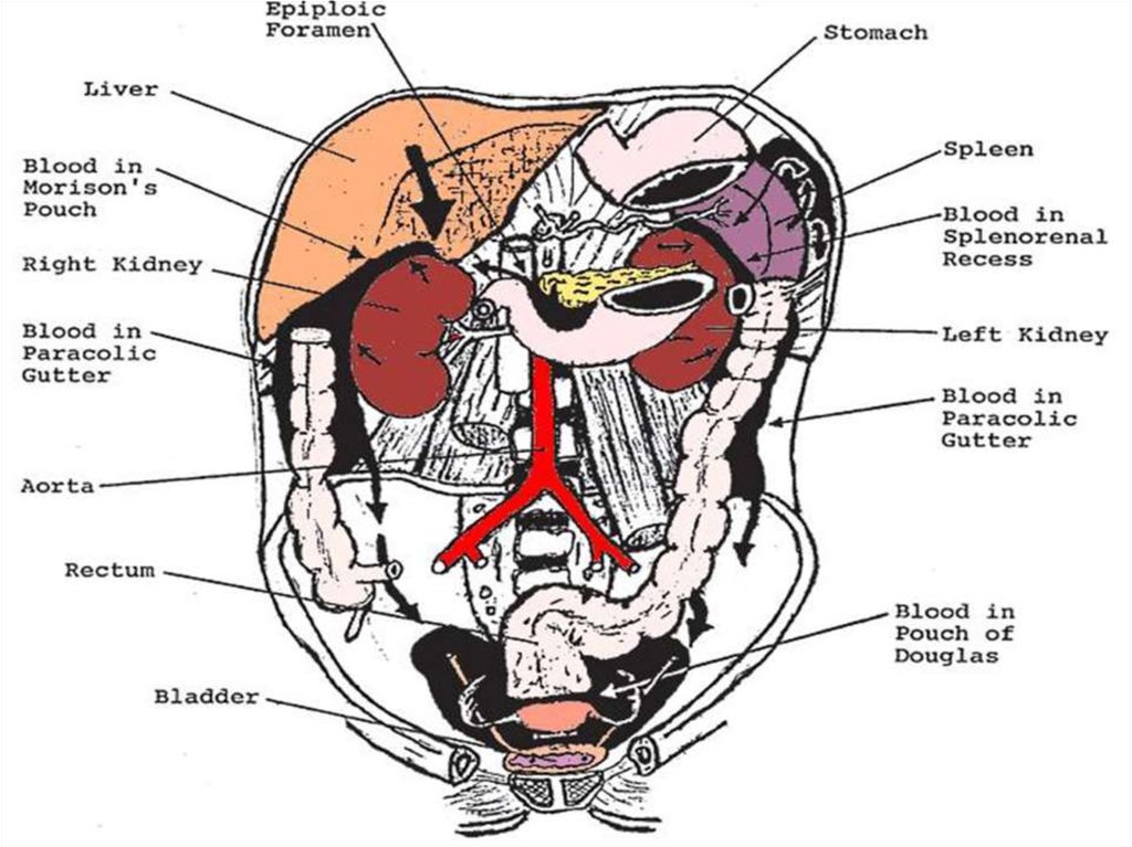 Fast протокол при травме. Фаст протокол узи. Fast протокол при сочетанной травме. Fast протокол узи. Fast protocol.