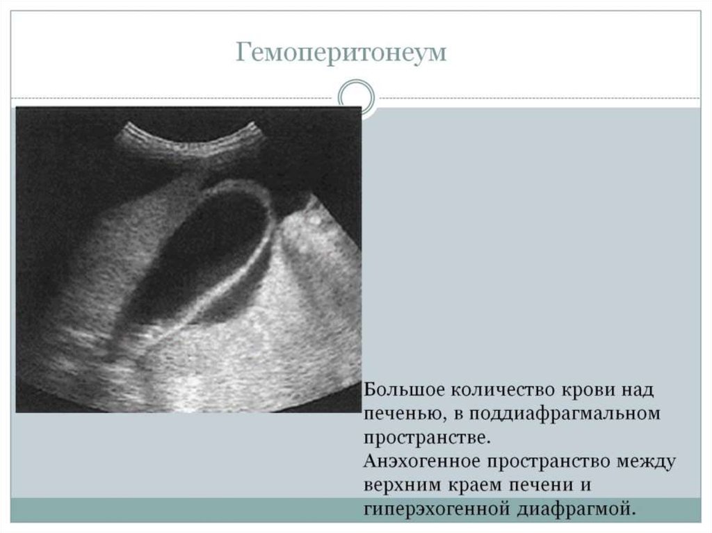 Гемоперитонеум