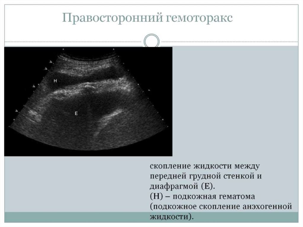 Правосторонний гемоторакс