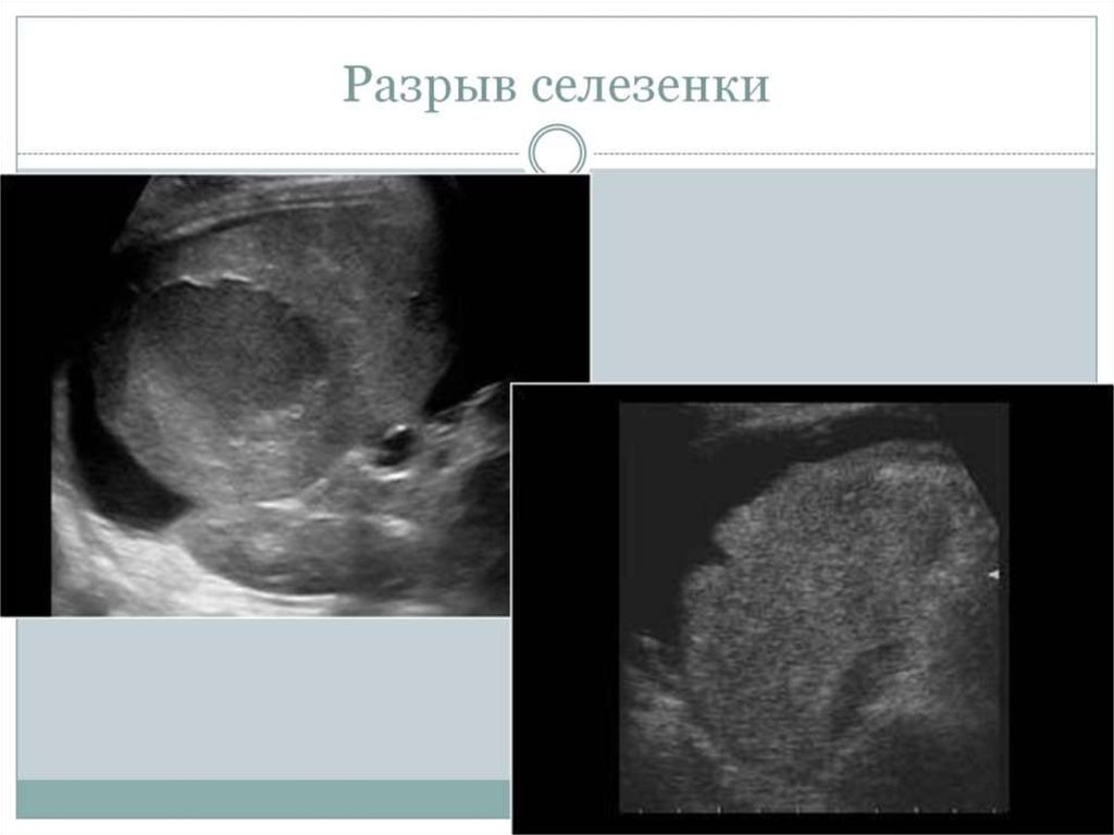 Разрыв селезенки. Чрезкапсульный разрыв селезенки. Подкапсульный разрыв селезенки на УЗИ. Одномоментный разрыв селезенки.