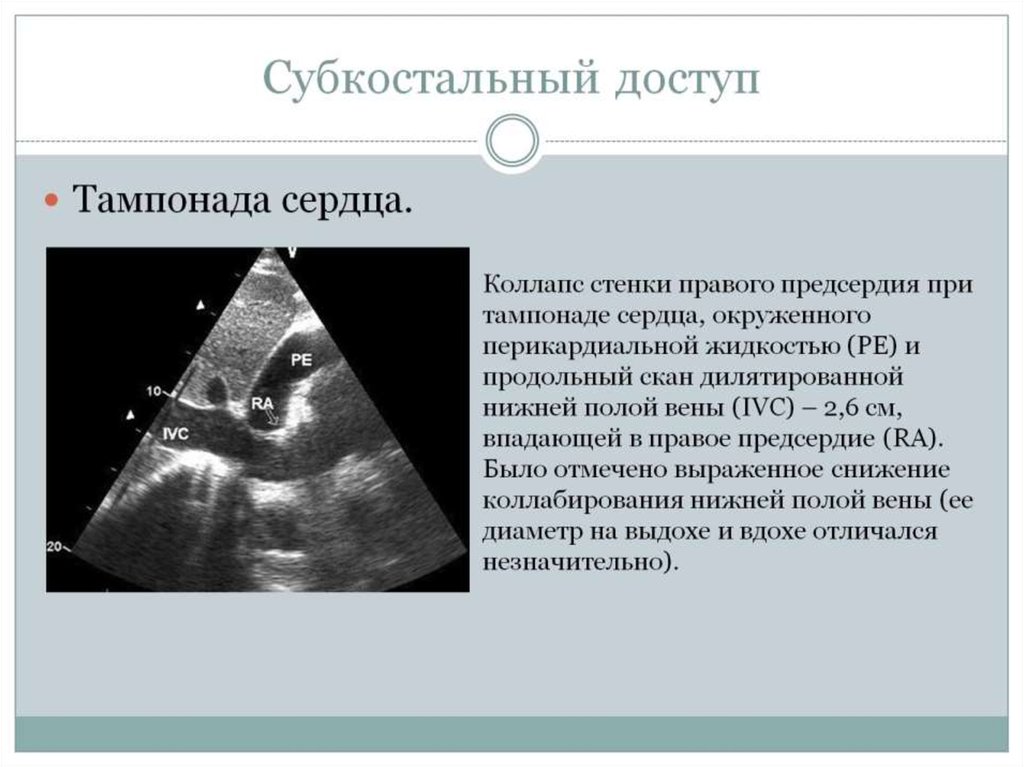 Коллабирование стенки правого предсердия