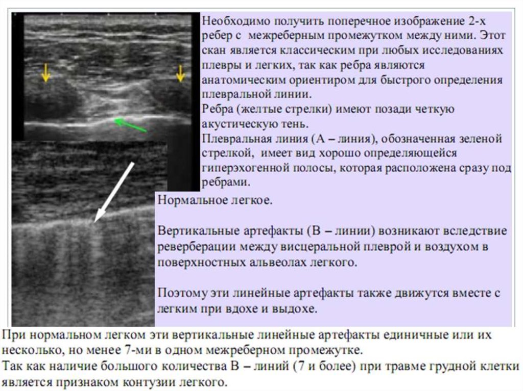 Узи легких протокол и плевры образец