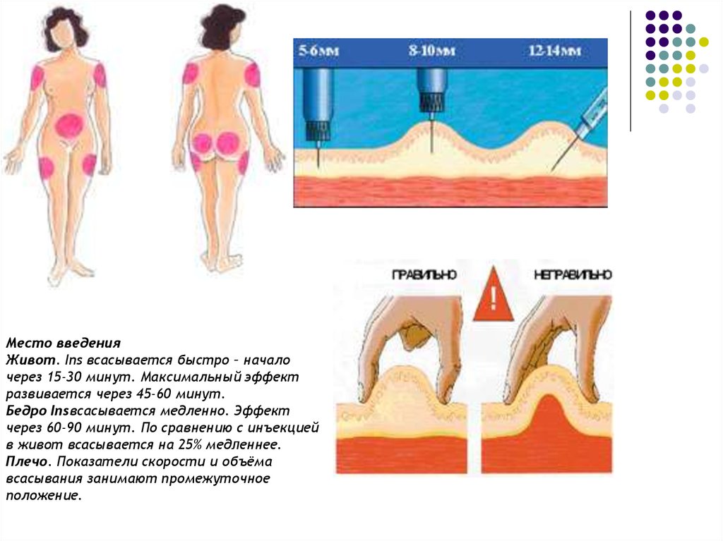 Как ставить подкожно в живот. Уколы Клексан в живот подкожно. Введение подкожно в живот. Подкожное Введение в живот места инъекции. Место укола в живот подкожно.