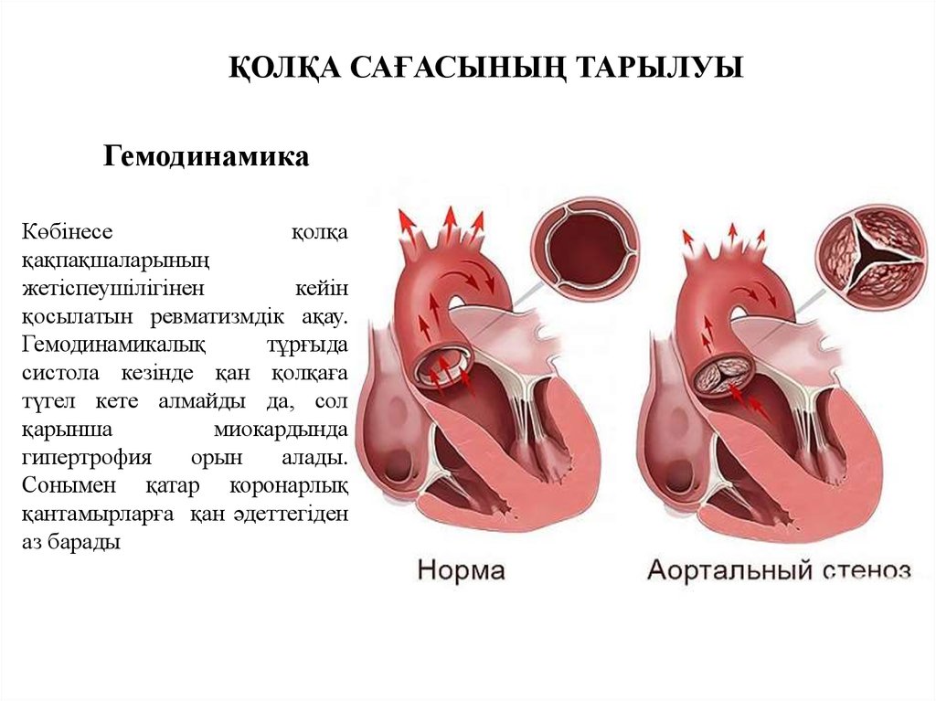 Порог сердца что это. Пороки сердца аортальный стеноз и недостаточность. Врожденные пороки сердца аортальный стеноз. Аортальный стеноз патофизиология.