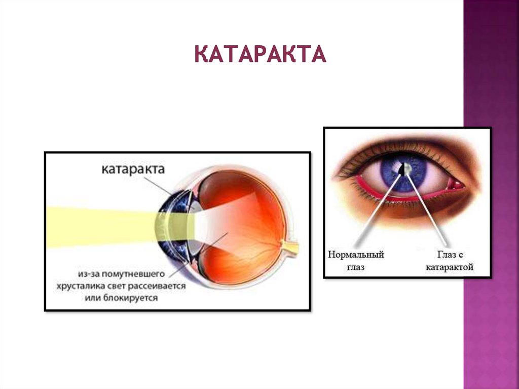 Глаз видит изображение. Проблемы с хрусталиком глаза. Аномалия хрусталика глаза. Зрение при катаракте. Неправильный хрусталик глаза.
