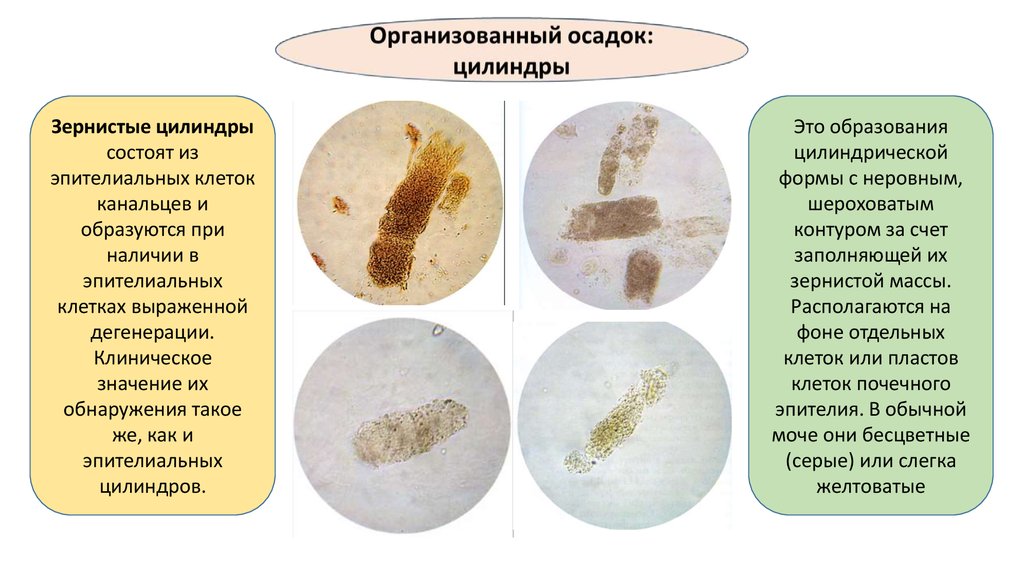 Почечный эпителий в осадке мочи