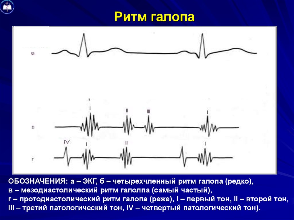 Схема ритма галопа