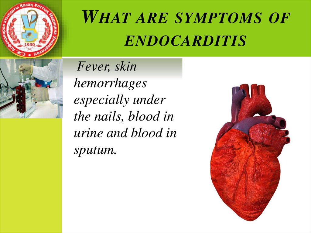 rheumatic-endocarditis